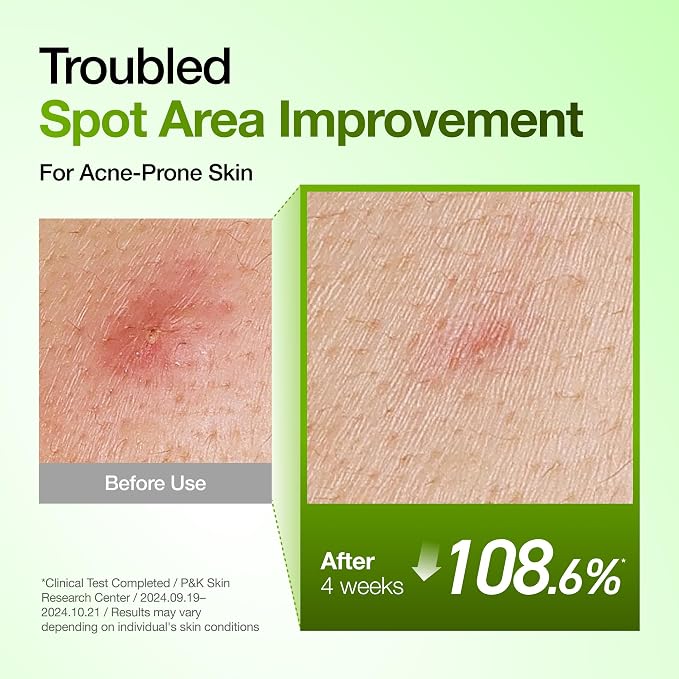 Anua Azelaic Acid 10% + Hyaluron Serum For Calm And Radiant Skin - 30Ml view 4