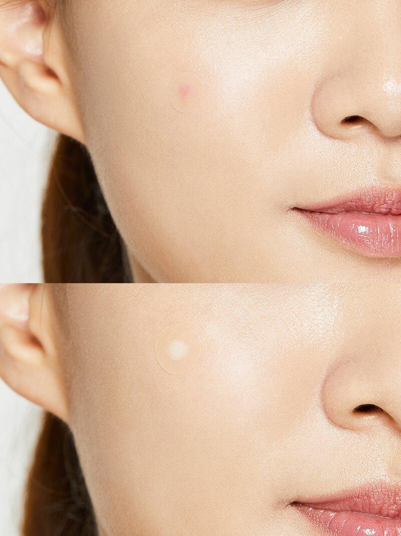 Cosrx Acne Pimple Master Patch – 24 patches view 3
