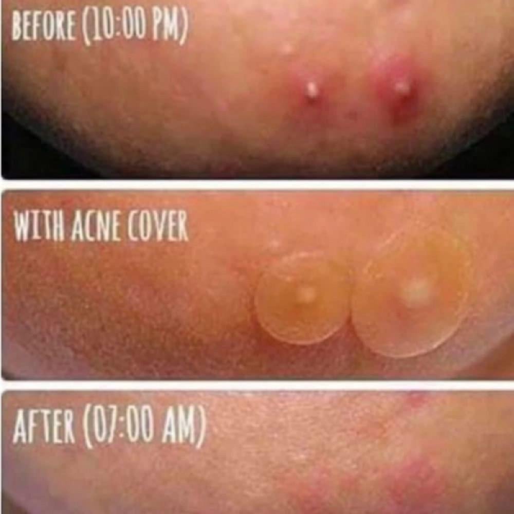 Some By Mi 30 Days Miracle Acne Clear Spot Patch - 18 Pieces view 4