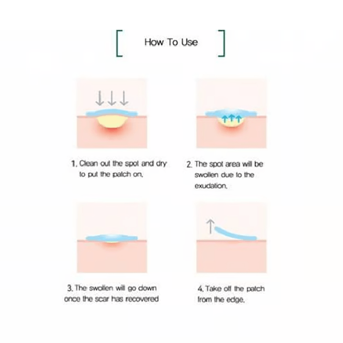 Some By Mi 30 Days Miracle Acne Clear Spot Patch - 18 Pieces view 3
